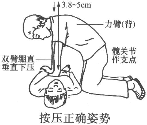 心肺复苏模拟人操作常见错误心肺复苏模型易犯错误