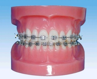 固定牙齿矫正模型（正常）图