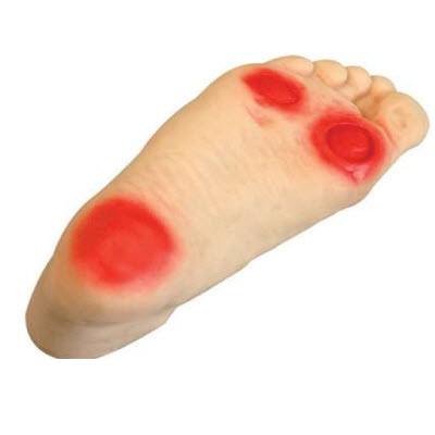 糖尿病人的足部护理